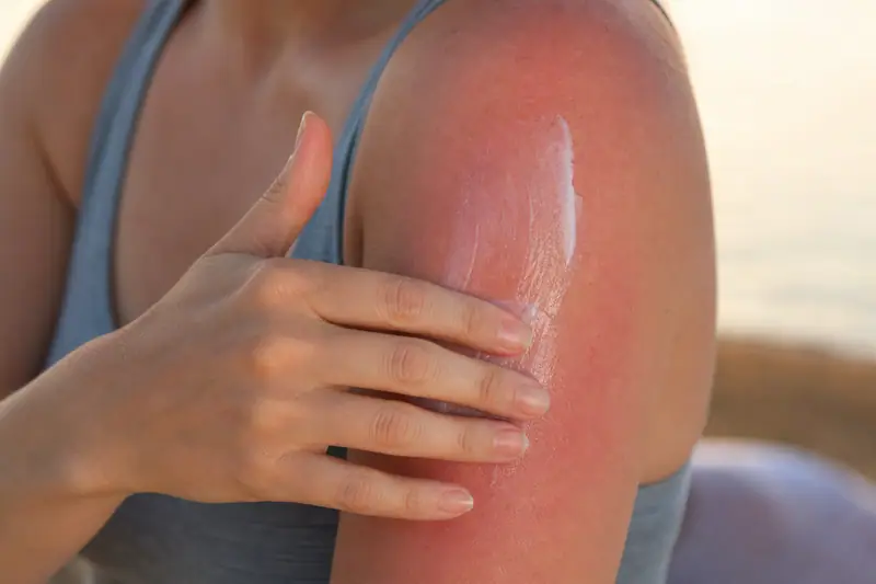Personne appliquant une crème hydratante sur son épaule bronzée en fin de journée d’été